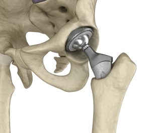 Best Doctors for Hip Replacement