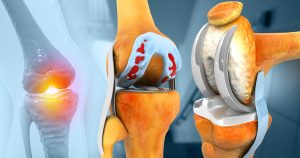 best total knee implants